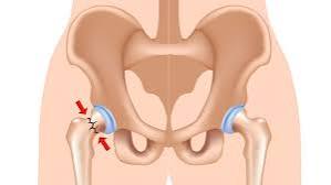 FRACTURA DE CADERA